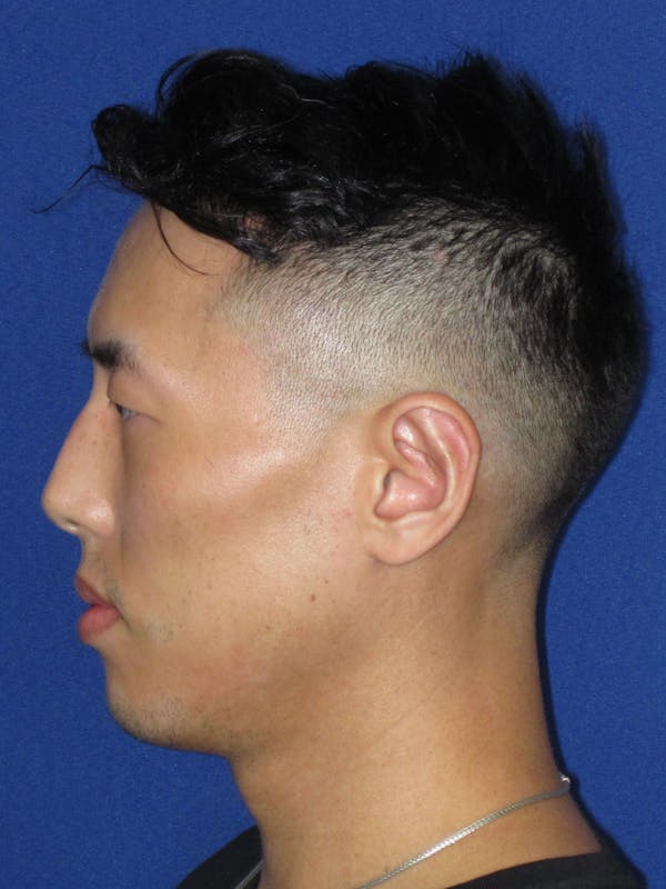 Otoplasty 