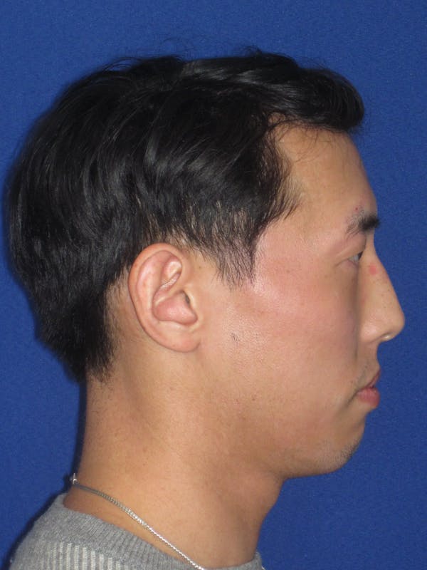 Otoplasty 