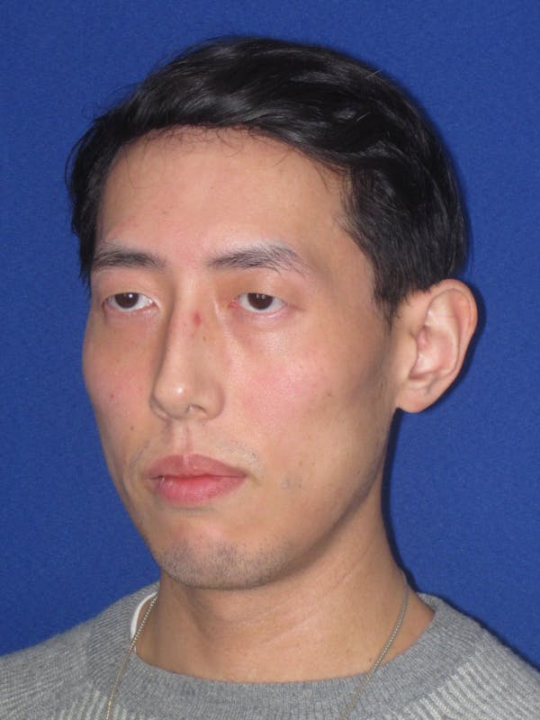 Otoplasty 