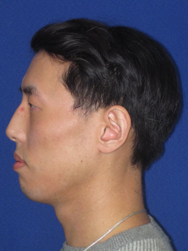 Otoplasty 