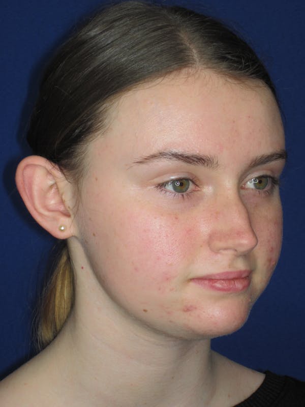 Otoplasty 
