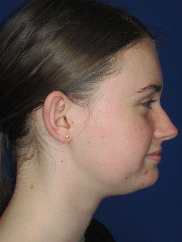 Otoplasty 