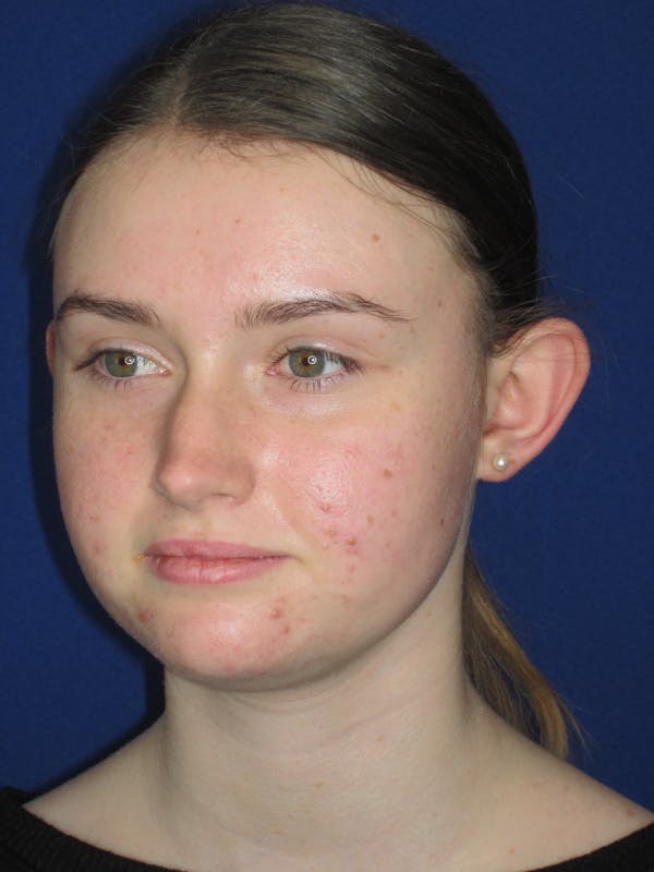 Otoplasty 