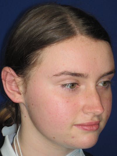 Otoplasty 