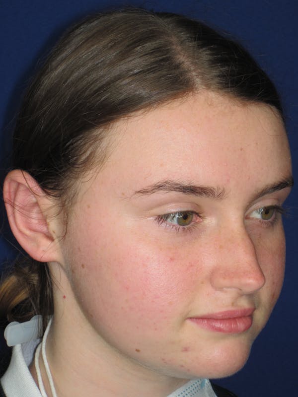 Otoplasty 