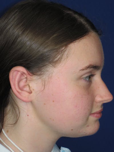 Otoplasty 