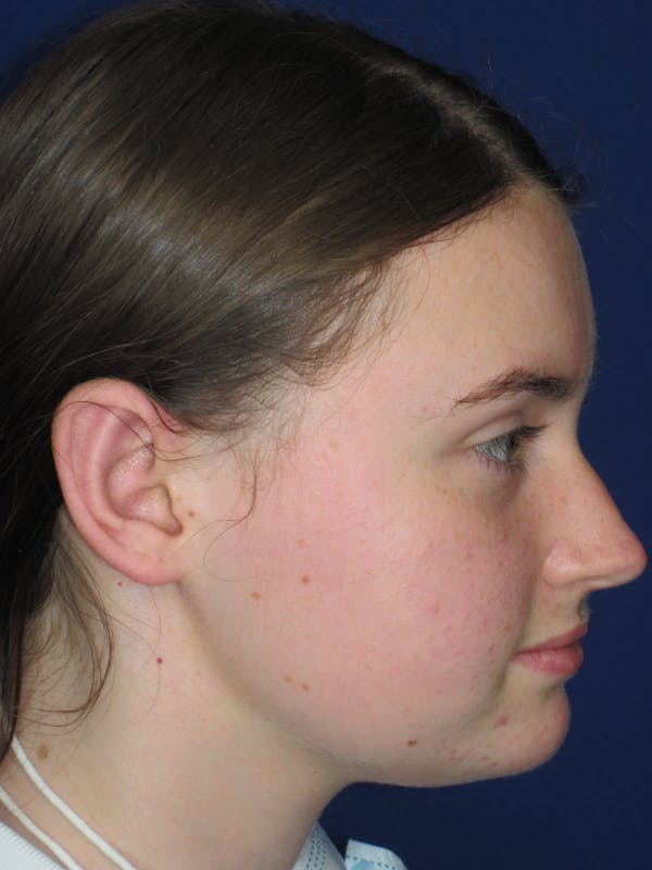 Otoplasty 