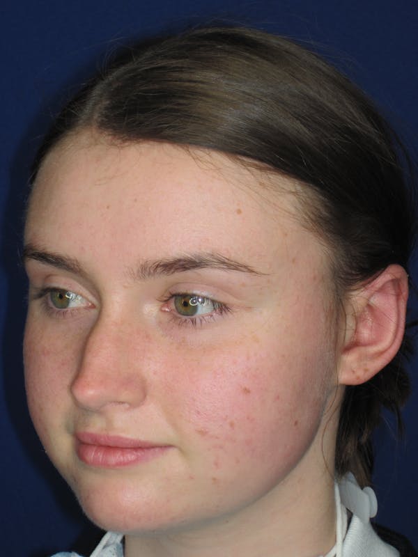 Otoplasty 