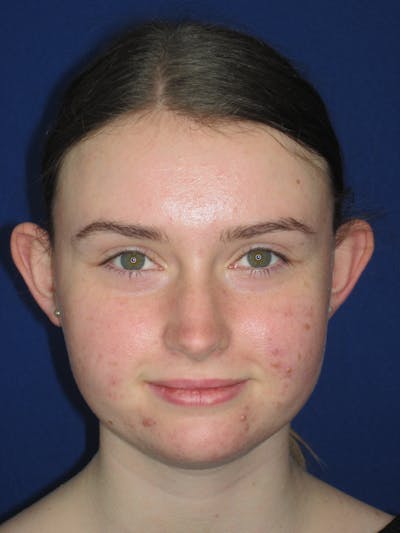 Otoplasty 