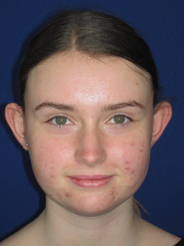 Otoplasty 