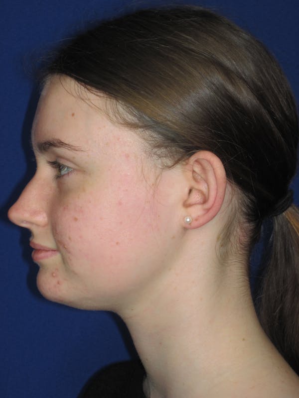 Otoplasty 