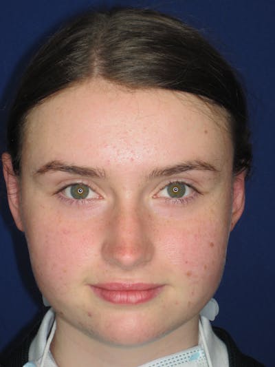 Otoplasty 