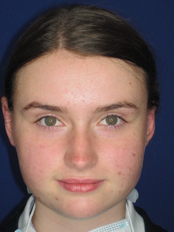 Otoplasty 