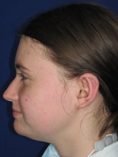 Otoplasty 