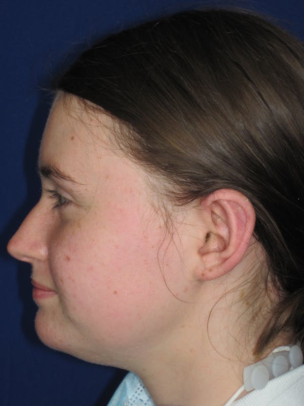 Otoplasty 