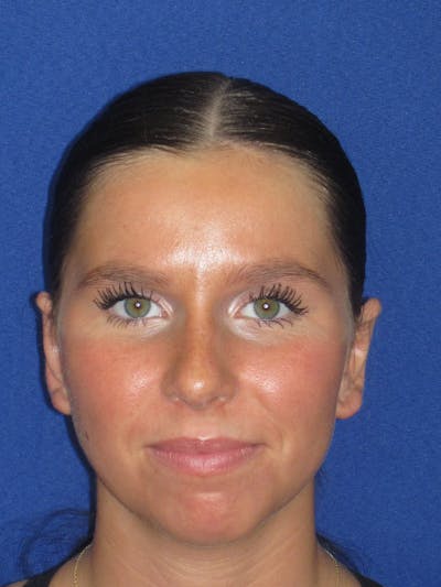Otoplasty