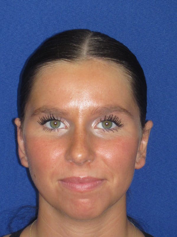 Otoplasty