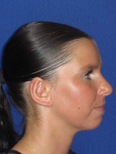 Otoplasty