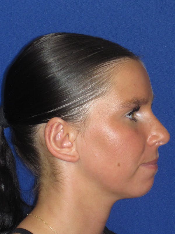 Otoplasty