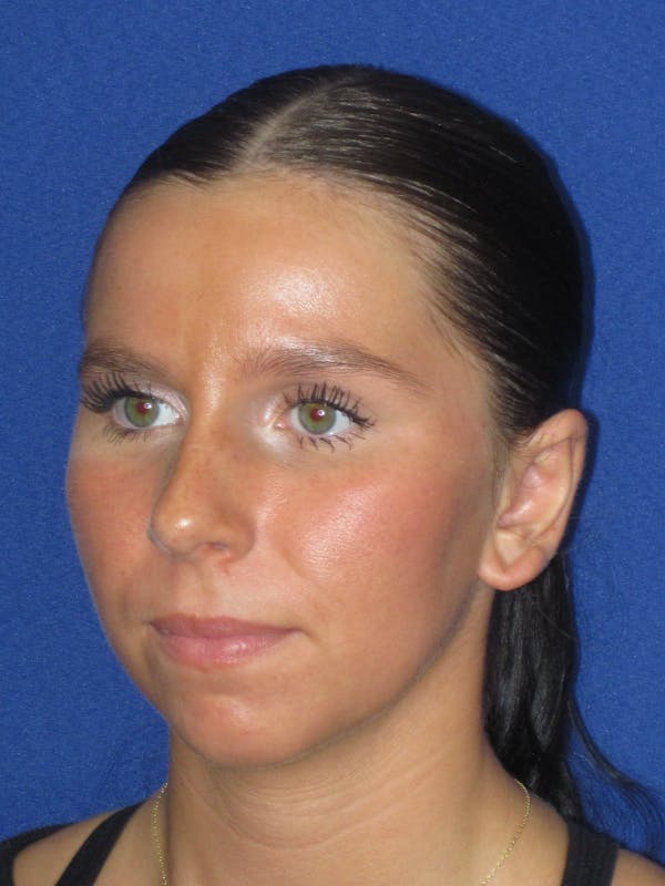 Otoplasty