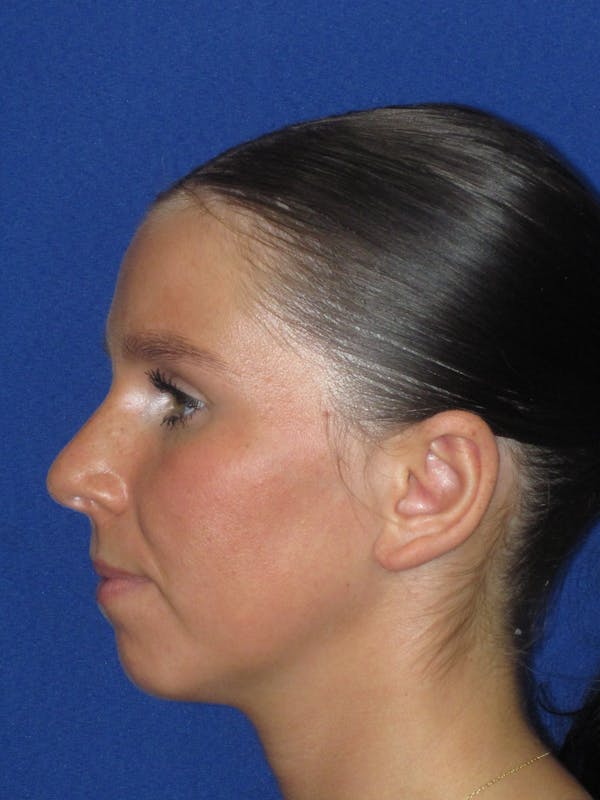 Otoplasty