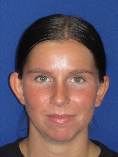 Otoplasty 