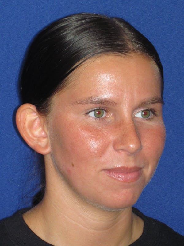 Otoplasty