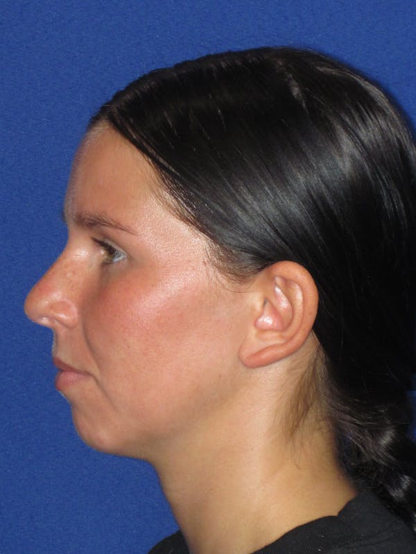 Otoplasty