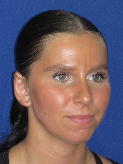 Otoplasty