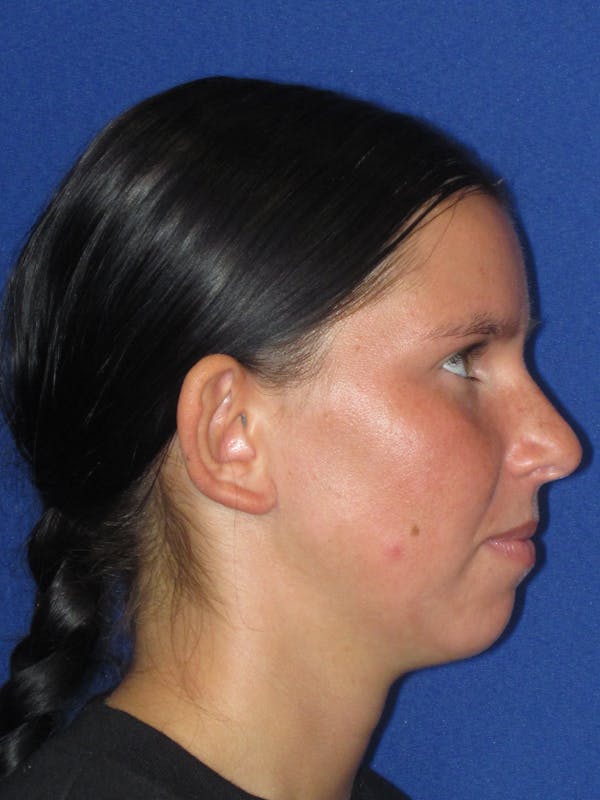 Otoplasty