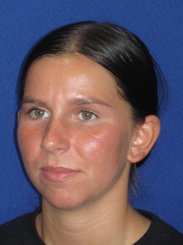 Otoplasty