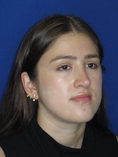 Rhinoplasty Before & After Gallery - Patient 425737 - Image 6