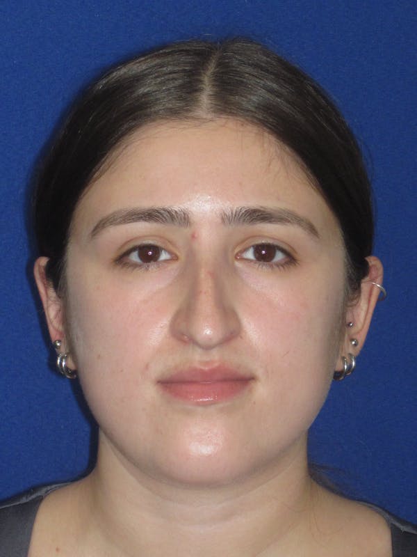 Rhinoplasty Before & After Gallery - Patient 425737 - Image 3
