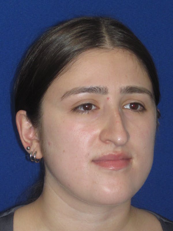 Rhinoplasty Before & After Gallery - Patient 425737 - Image 5