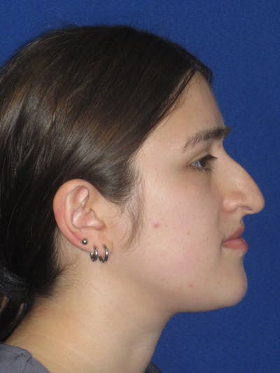 Rhinoplasty Before & After Gallery - Patient 425737 - Image 1