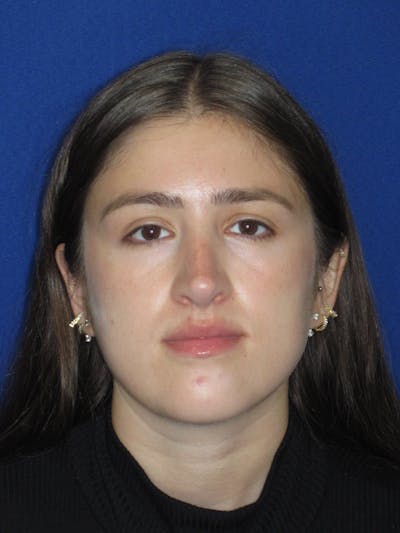 Rhinoplasty Before & After Gallery - Patient 425737 - Image 4
