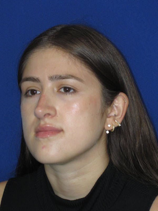 Rhinoplasty Before & After Gallery - Patient 425737 - Image 8