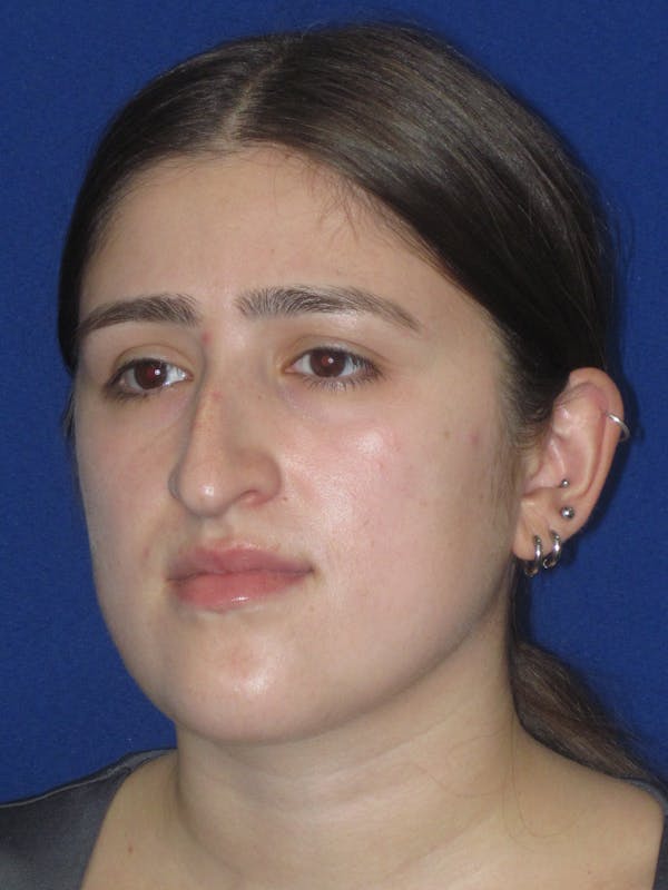 Rhinoplasty Before & After Gallery - Patient 425737 - Image 7