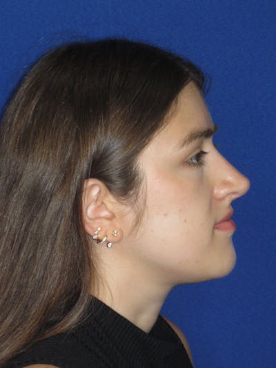 Rhinoplasty Before & After Gallery - Patient 425737 - Image 2
