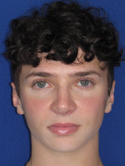 Rhinoplasty Before & After Gallery - Patient 144022 - Image 4