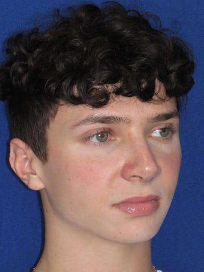 Rhinoplasty Before & After Gallery - Patient 144022 - Image 6