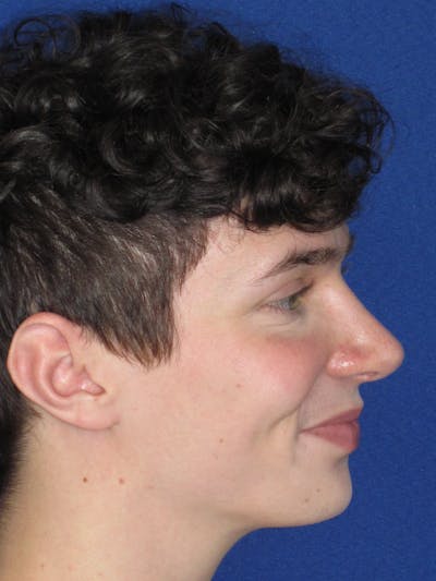 Rhinoplasty Before & After Gallery - Patient 144022 - Image 8