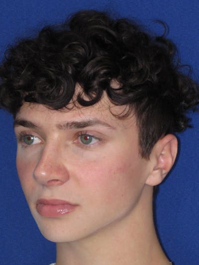 Rhinoplasty Before & After Gallery - Patient 144022 - Image 10