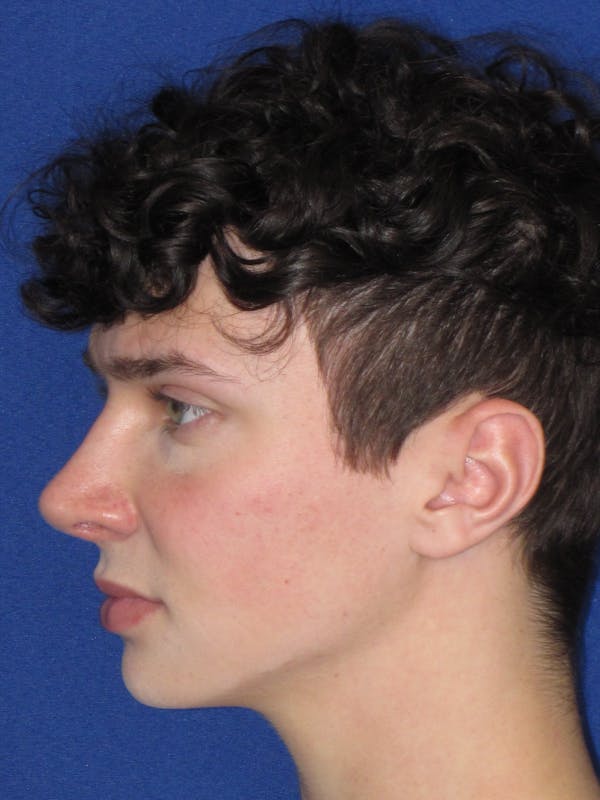 Rhinoplasty Before & After Gallery - Patient 144022 - Image 12
