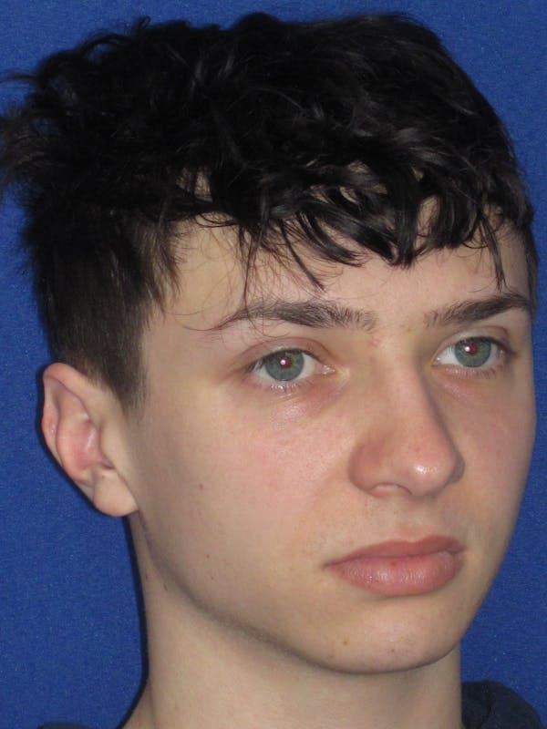 Rhinoplasty Before & After Gallery - Patient 144022 - Image 5