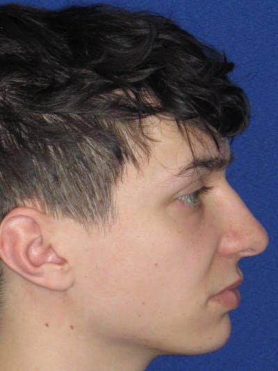 Rhinoplasty Before & After Gallery - Patient 144022 - Image 1