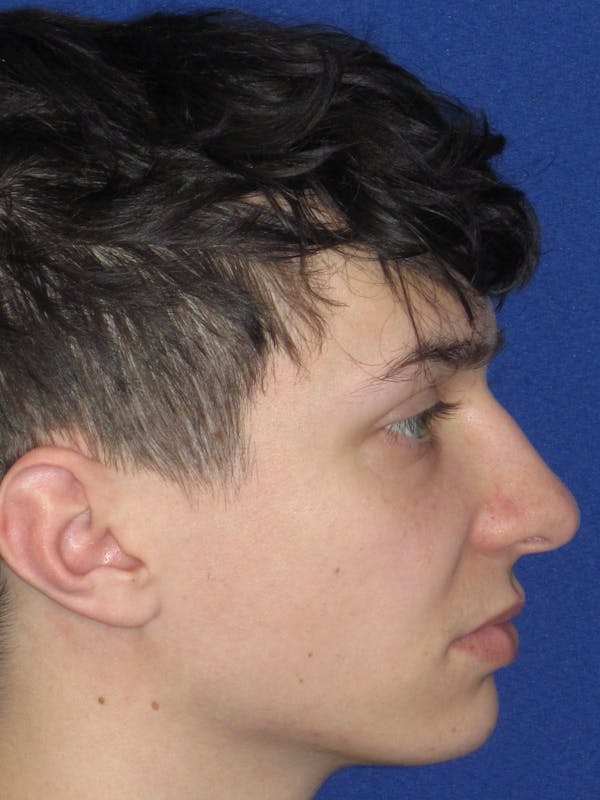Rhinoplasty Before & After Gallery - Patient 144022 - Image 1