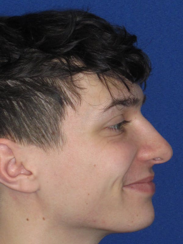 Rhinoplasty Before & After Gallery - Patient 144022 - Image 7