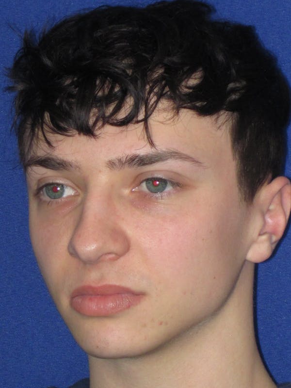 Rhinoplasty Before & After Gallery - Patient 144022 - Image 9