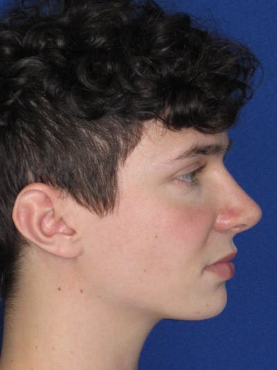 Rhinoplasty Before & After Gallery - Patient 144022 - Image 2